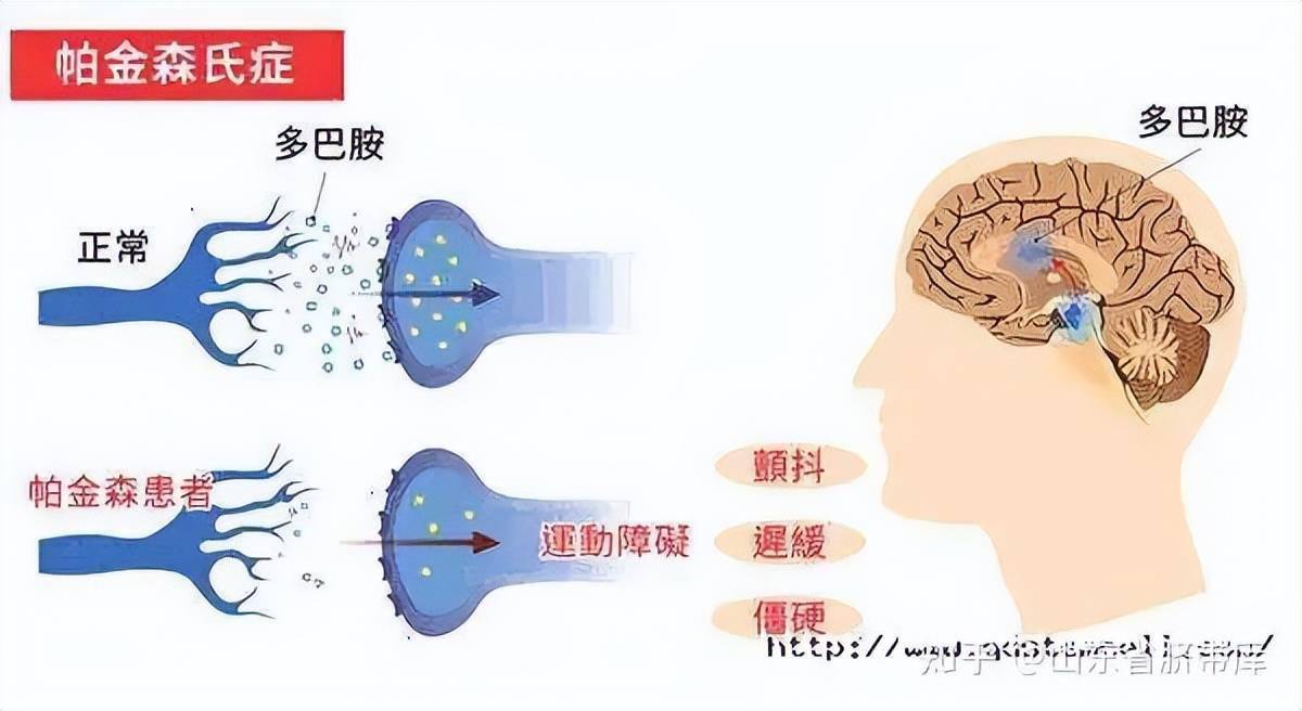 据了解,由于帕金森病是"中脑黑质多巴胺能神经元的变性死亡而导致的"