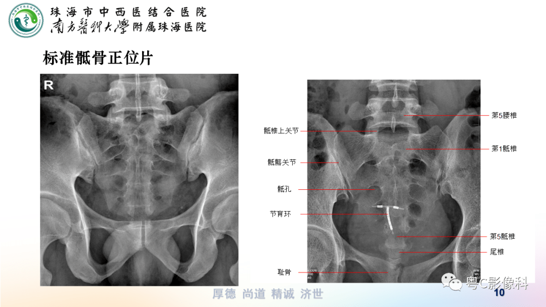 骶椎X线图片