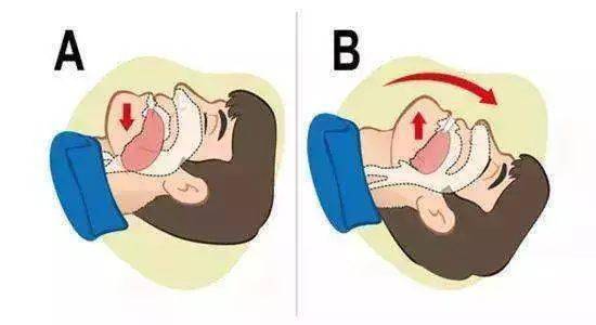 健康素养66条逐条解读~~~第63条_病人_伤病员_人工呼吸