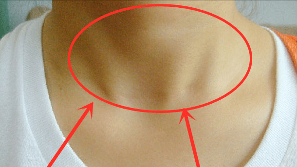 甲状腺结节照片图片