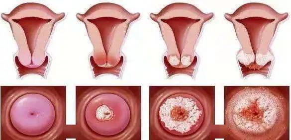 hpv(人乳头状瘤病毒)是最近几年的网红热门词,它是宫颈癌的罪魁祸首