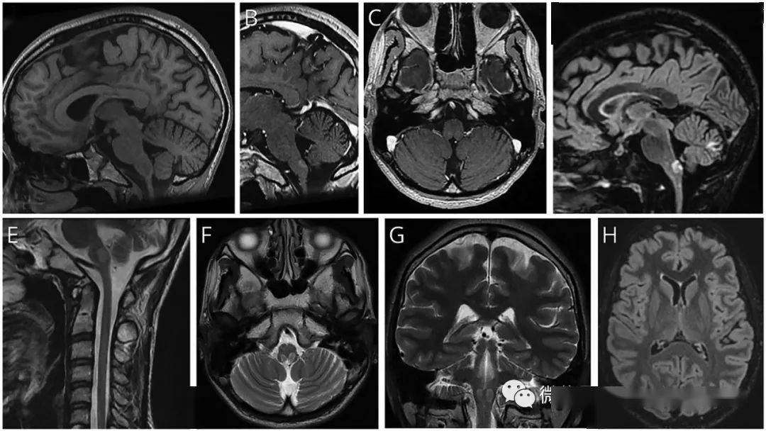 极后区综合征作为亚历山大病的首发表现