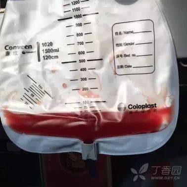 关于出入量记录,普通病人若不导尿可以采用尿壶(有刻度)记录;对于尿