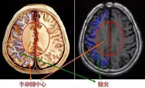 大脑放射冠图片