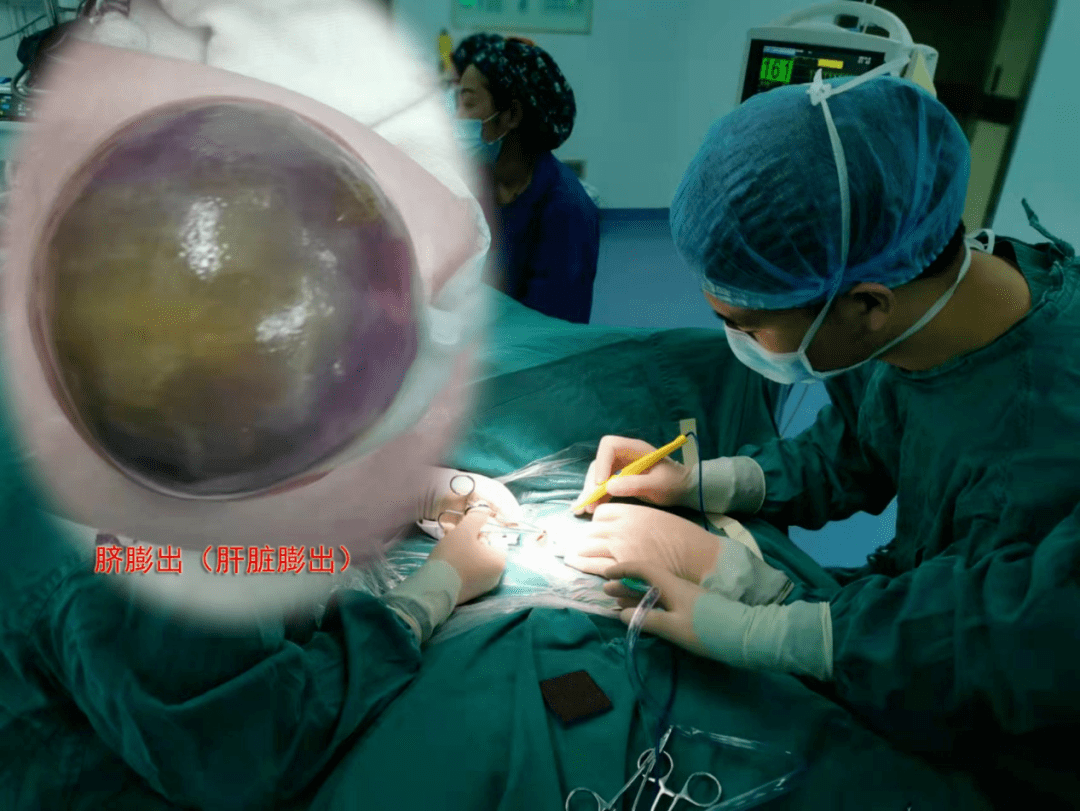 保健院成功救治1例双胎输血综合征合并巨型脐膨出_杜女士_胎儿_手术