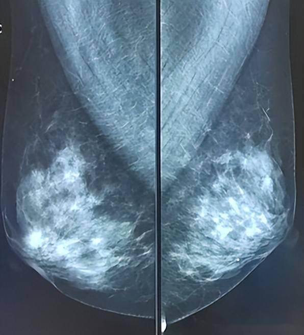乳腺癌早期b超单图图片