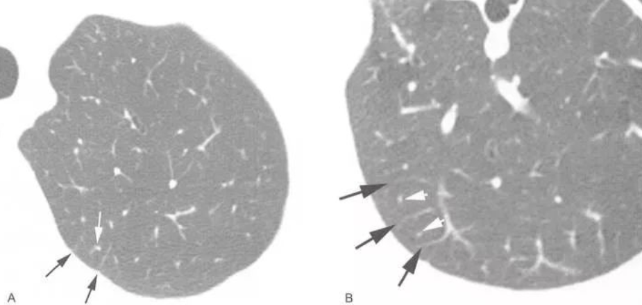 学习肺部ct一起来看看次级肺小叶有多少相关疾病与征象