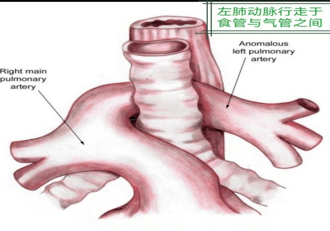 最后进入左肺门,形成环绕气管但不环绕食管的