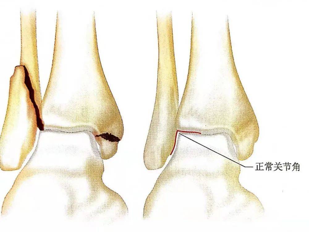 全面解析 踝关节骨折的手术治疗技巧与预后处理 韧带 胫骨 检查