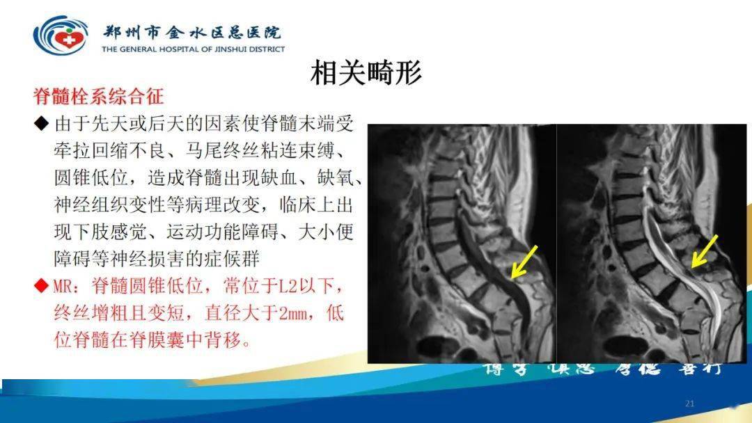 脊髓纵裂及相关疾病影像表现
