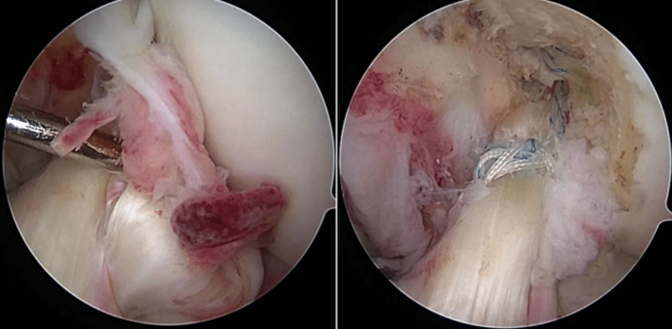 女子骑车摔倒致前交叉韧带断裂湘雅专家微创手术成功复位