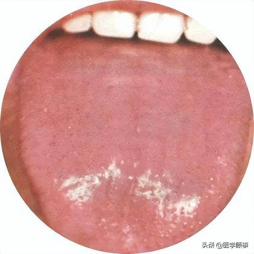 丝状乳头,菌状乳头由于不同原因发生萎缩,严重时舌面光滑如镜,称为
