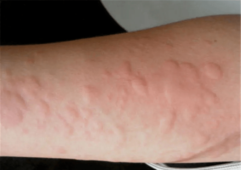 一到春季就奇痒无比风疙瘩威力到底有多大