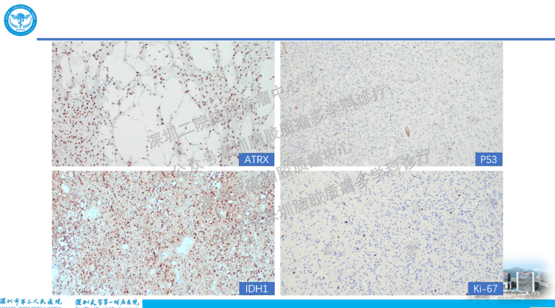 会议报道2022年4月期深圳二院疑难脑胶质瘤mdt简报