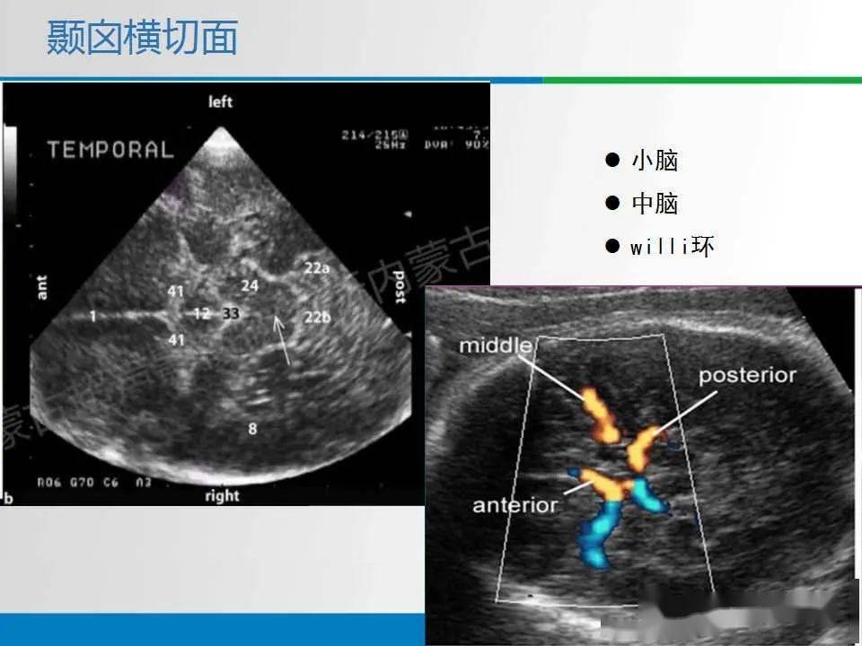 小脑蚓部超声图解图片