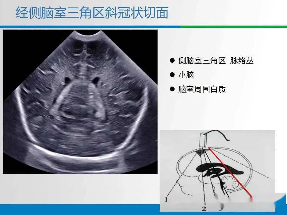 小脑蚓部超声图解图片