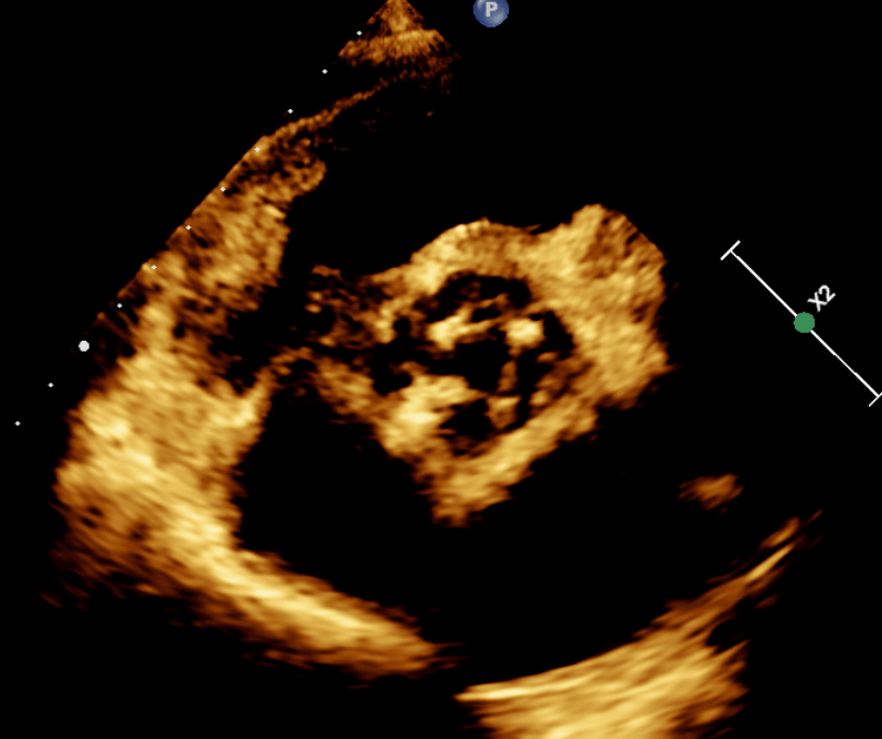 估测压力阶差约 42mmhg视频 2 经食管超声心动图显示距离主动脉瓣环