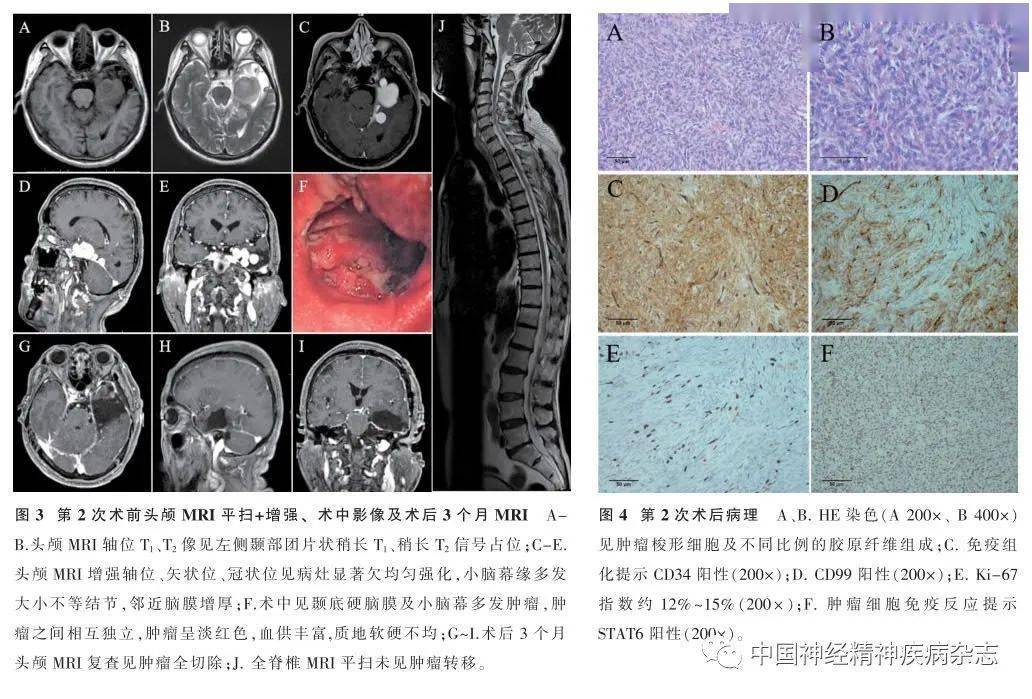 病例报告|颅内孤立性纤维瘤复发伴颅内多发转移1例