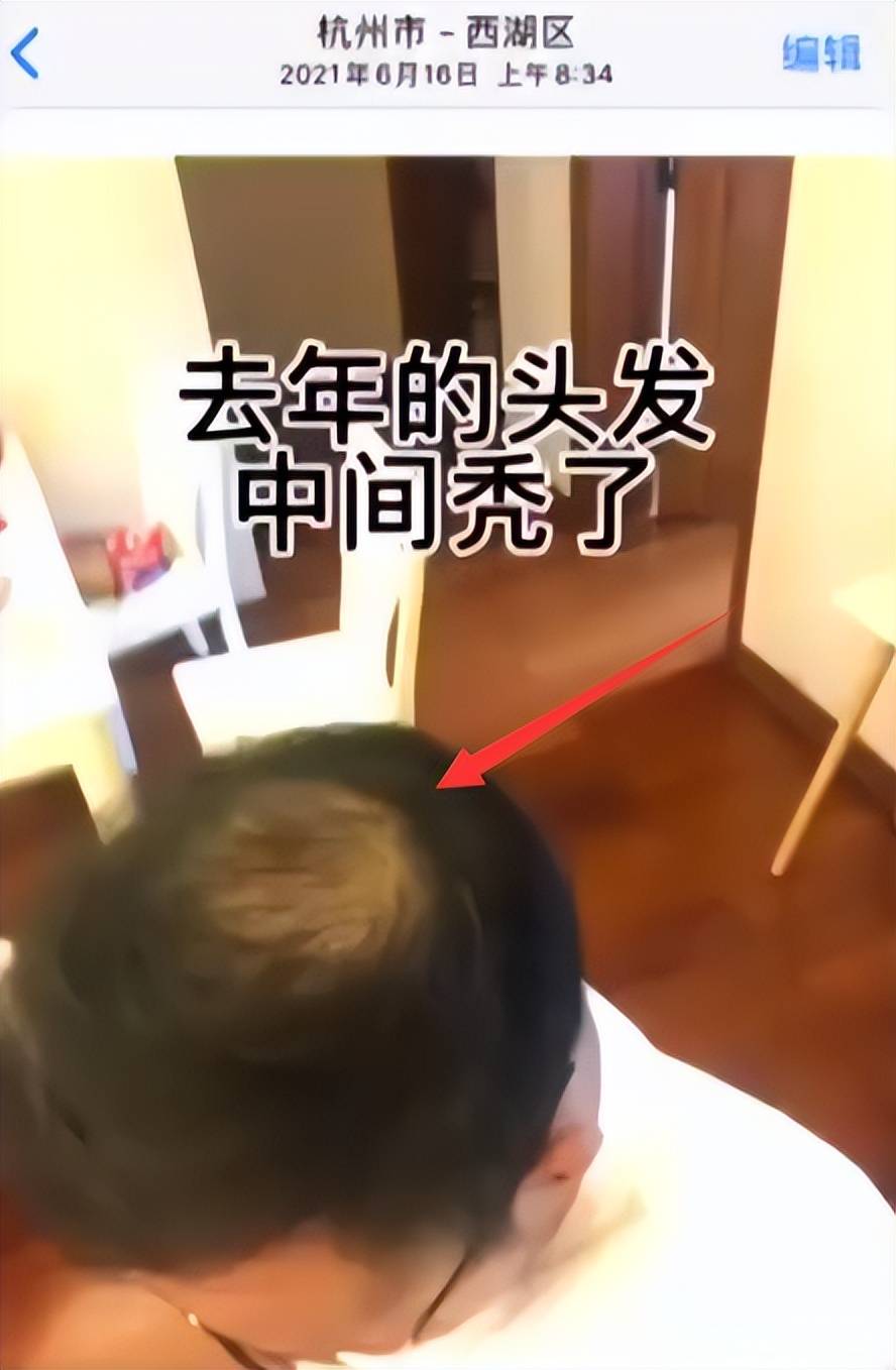 秃顶男子称半个月不用洗发水长出头发又粗又硬还不油