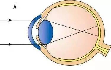 近視是眼球的哪個地方出錯了?_屈光_訓練_視覺