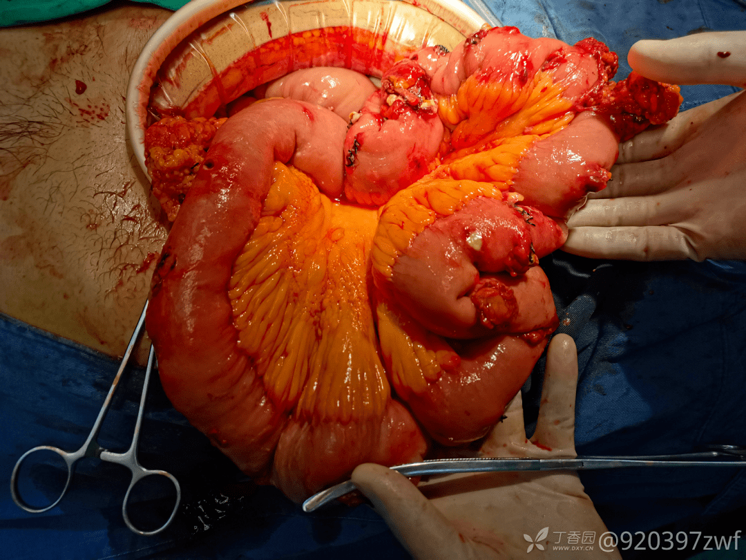 一根肠子上30多个穿孔还有很多快穿的求病理