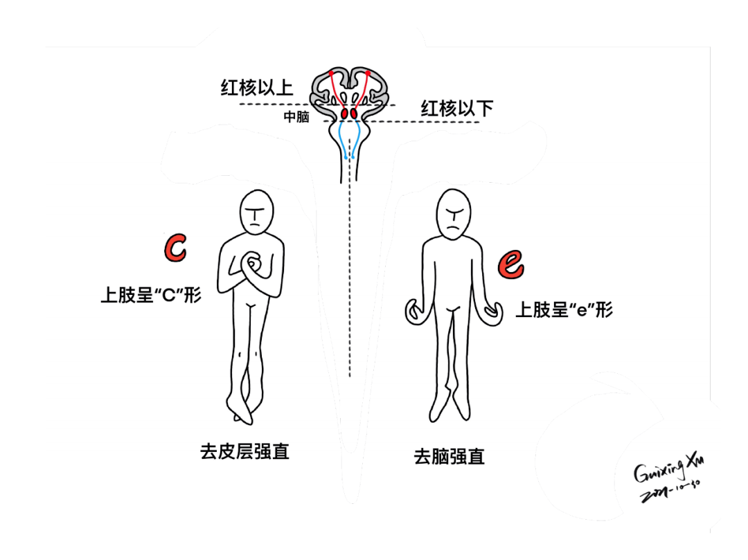 去皮层强直,去脑强直weber(大脑脚)综合征中脑顶盖位置及上丘切面锥体