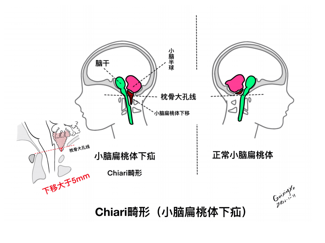 腦幹與顱神經的解剖與臨床【2】_位置_小腦_扁桃體