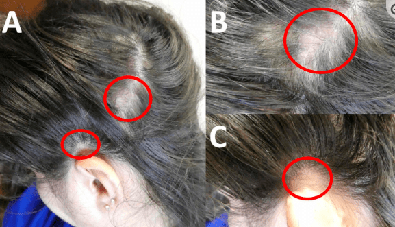 盘状红斑狼疮患者头发临床改变及皮肤镜检(图片来源于参考文献5)狼疮