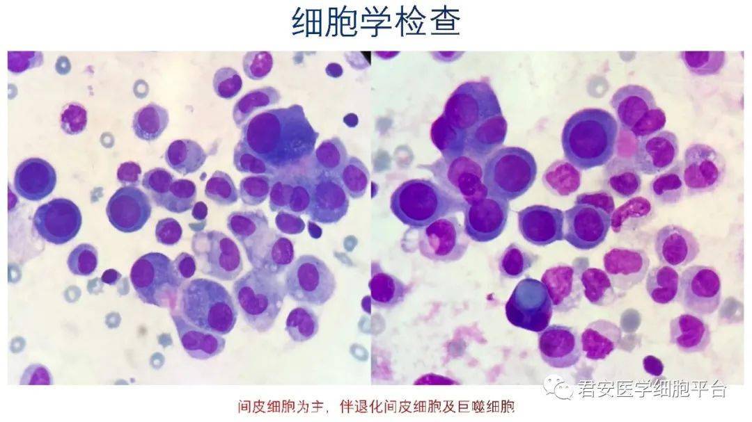 漿膜腔積液細胞學檢查案例分享