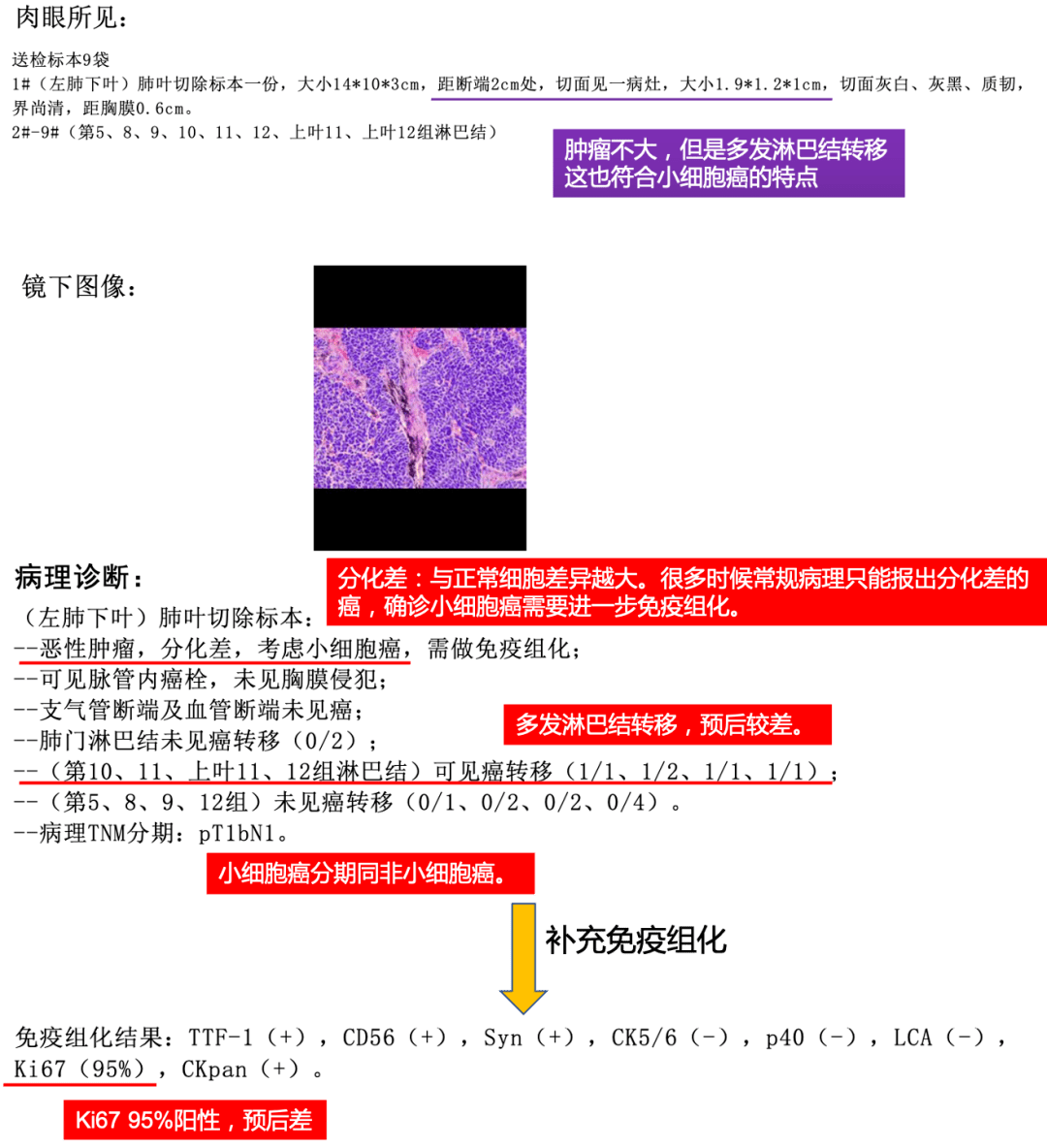 如何看懂肺癌【病理报告】?