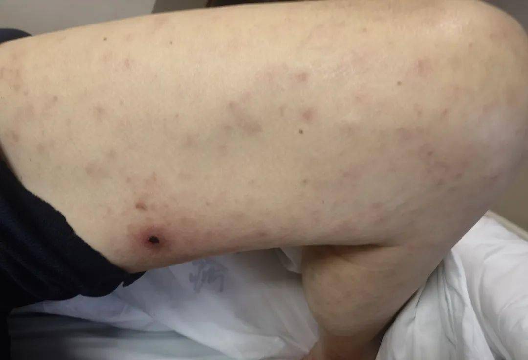 杭州多人被这种虫子咬伤_恙虫_患者_症状