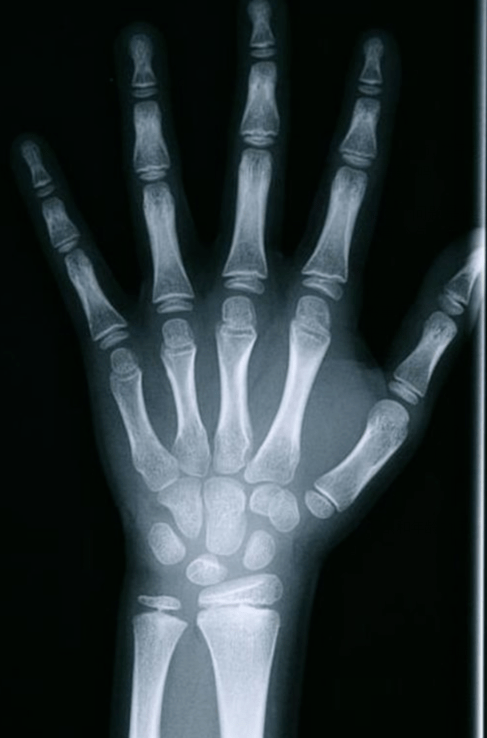 家长要做的,通常只需要带孩子拍一张(左)手腕部的x光片.