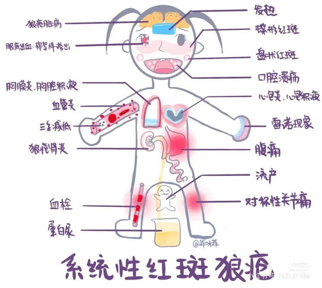 一文带你了解系统性红斑狼疮