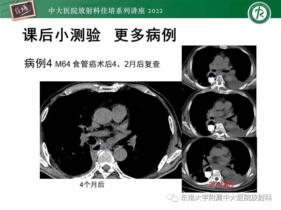 心包脂肪垫ct图片