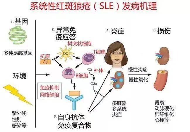 一文带你了解系统性红斑狼疮