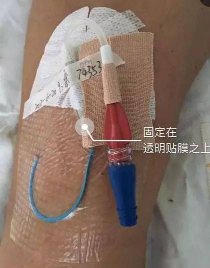 用透明薄膜将picc导管固定妥当,取3m胶带先包裹picc导管连接器的外露
