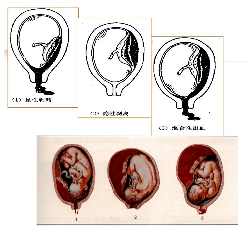 胎盘血肿图片图片