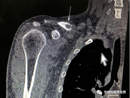 ct平掃 三維重建:右側鎖骨中遠段見斑片狀低密度骨質破壞區,邊界欠