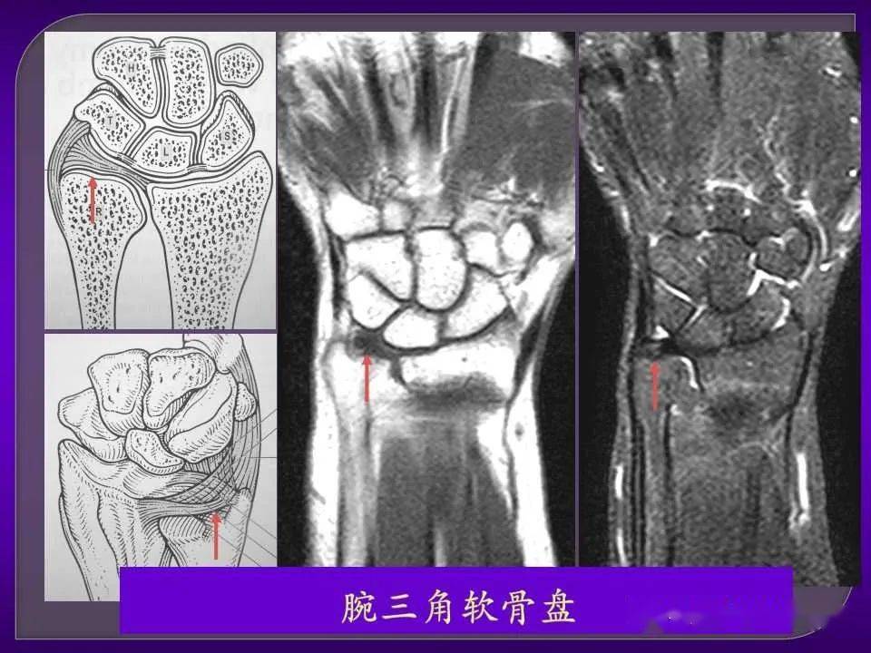 详细篇腕关节解剖及常见病变mri表现