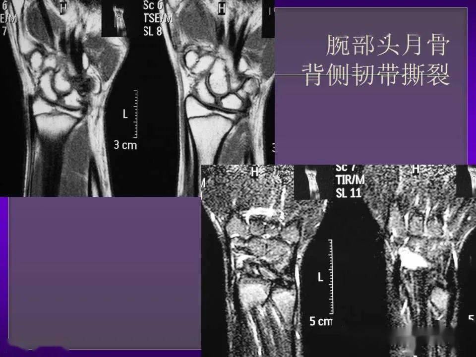 拇长屈肌腱解剖图mri图片