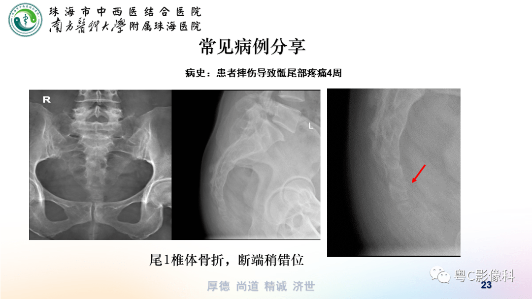 骶尾椎正侧位x线图图片