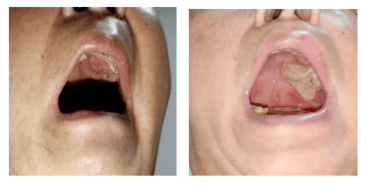 图25,四线治疗3个月,患者左上颚肿块变化情况:左(2020