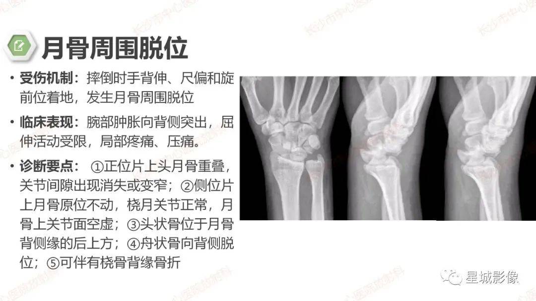 注意解剖細節標準的成像方法:x線 ct mri注意腕骨的正常解剖與變異副