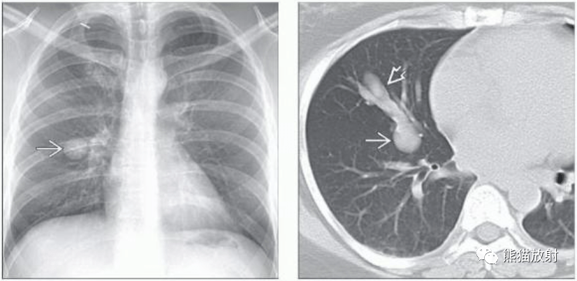 (左 一例典型类癌患者的pa胸片显示一右肺中叶边