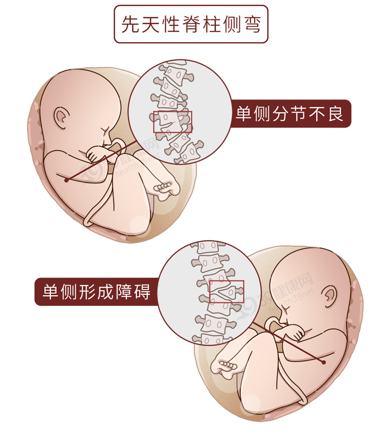 (如半椎体畸形)一是在妈咪肚子里发育得不好①先天性:哪些原因会让你