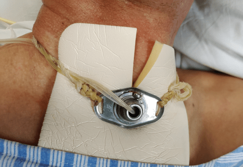 气管切开套管种类各异护理有何不同看这一篇