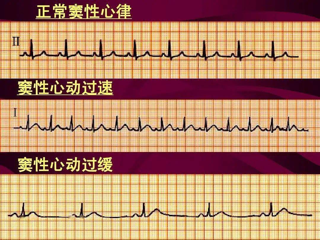 健康知识心电图检查中的窦性心律你知道是啥不