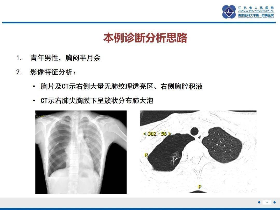 炸裂的泡泡67原發性自發性氣胸