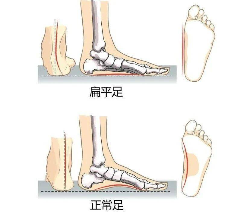 想改善扁平足戳