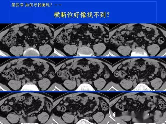 急性阑尾炎ct片图片图片